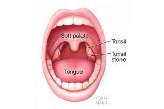 AUTHOR Dr Shulman Leave A Comment   Tonsil Stone 2 